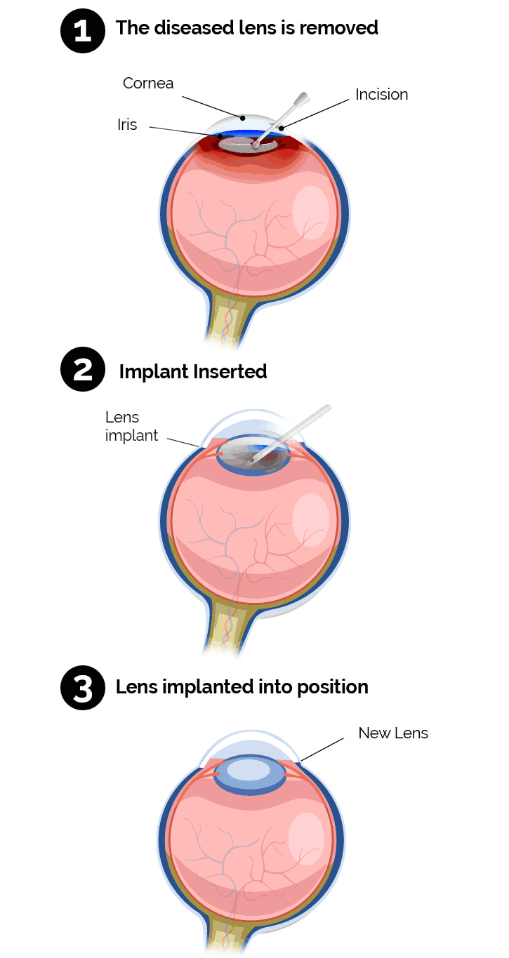 What Happens During Cataract Surgery