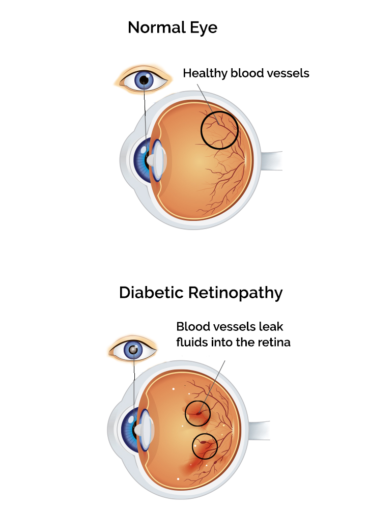 noraml eye and an eye with  diabetic retinopathy
