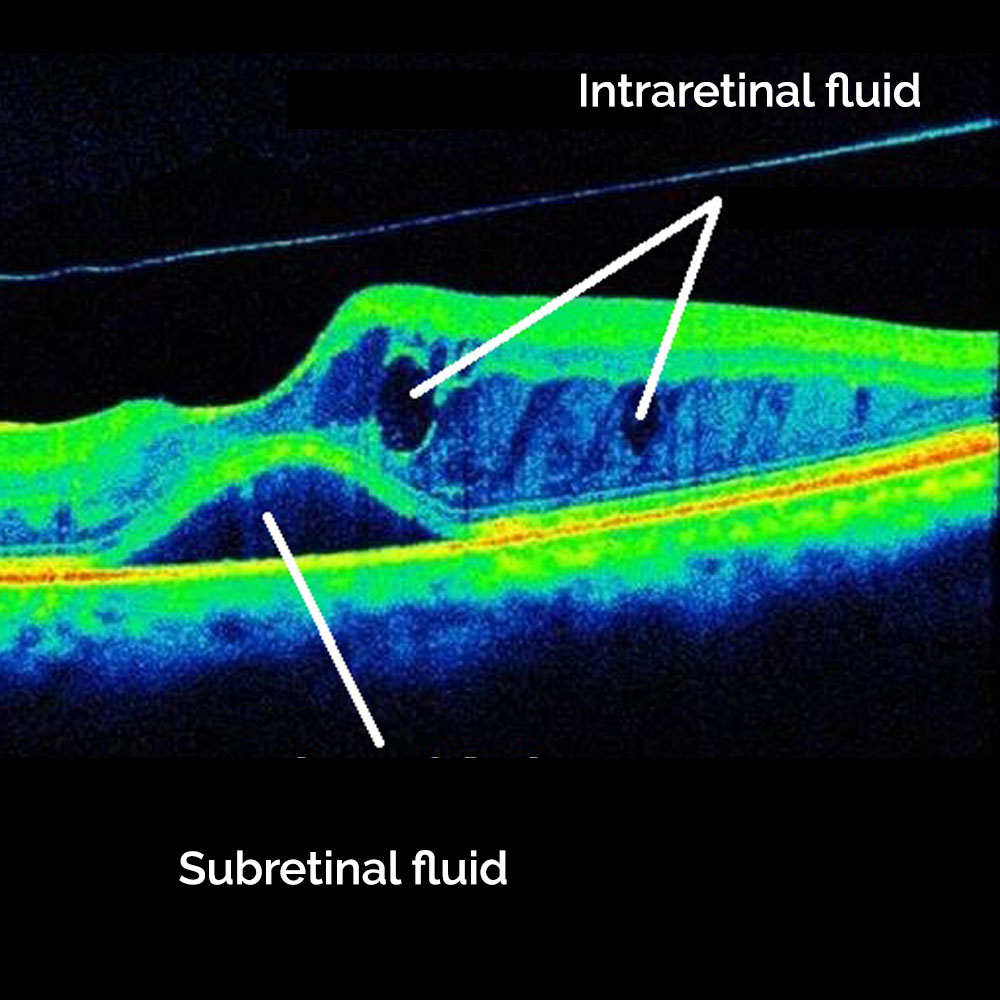 diabetic-retinopothy-oct-scan