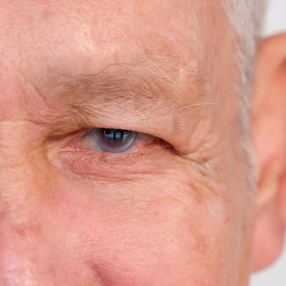 Man with macular degeneration