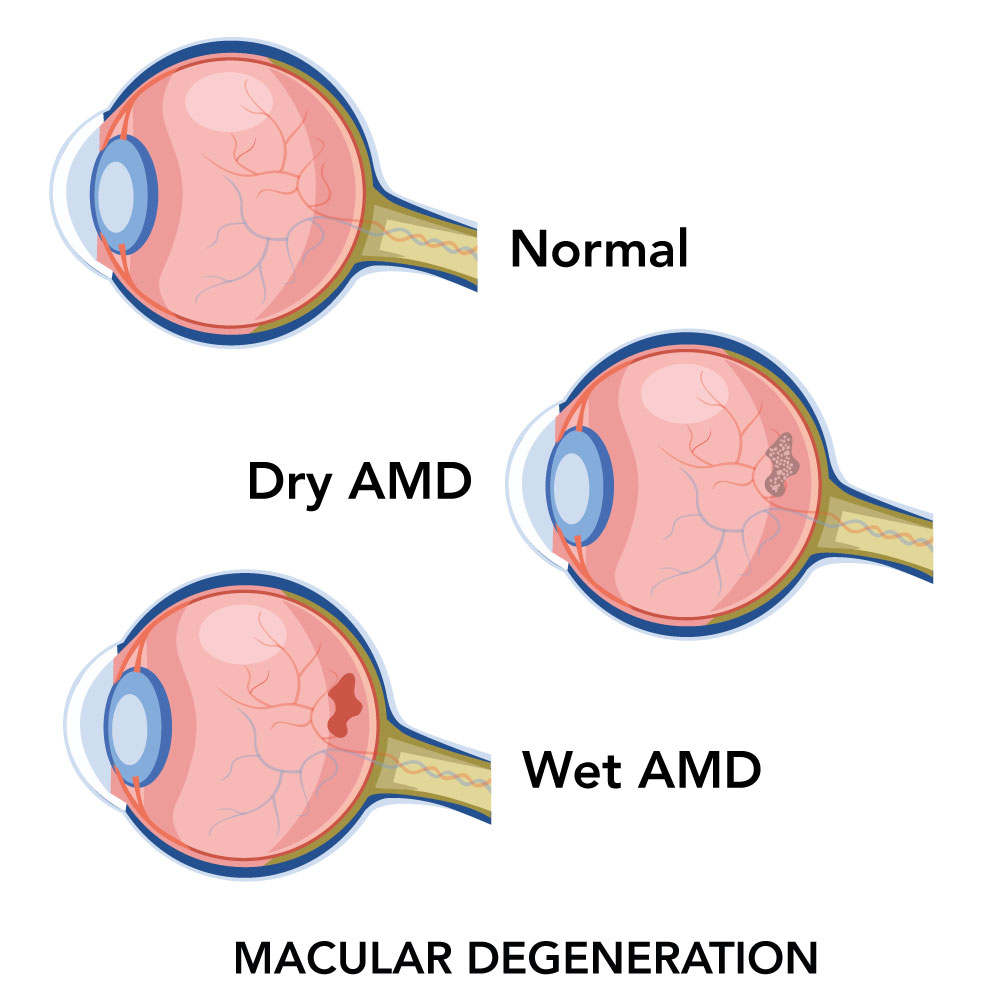 macular degeneration types