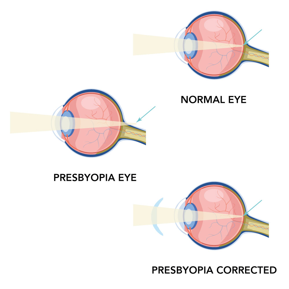 normal eye compaed to an ey with presbyopia
